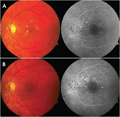 Retinal Physician PentaVision