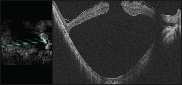 Retinal Physician PentaVision