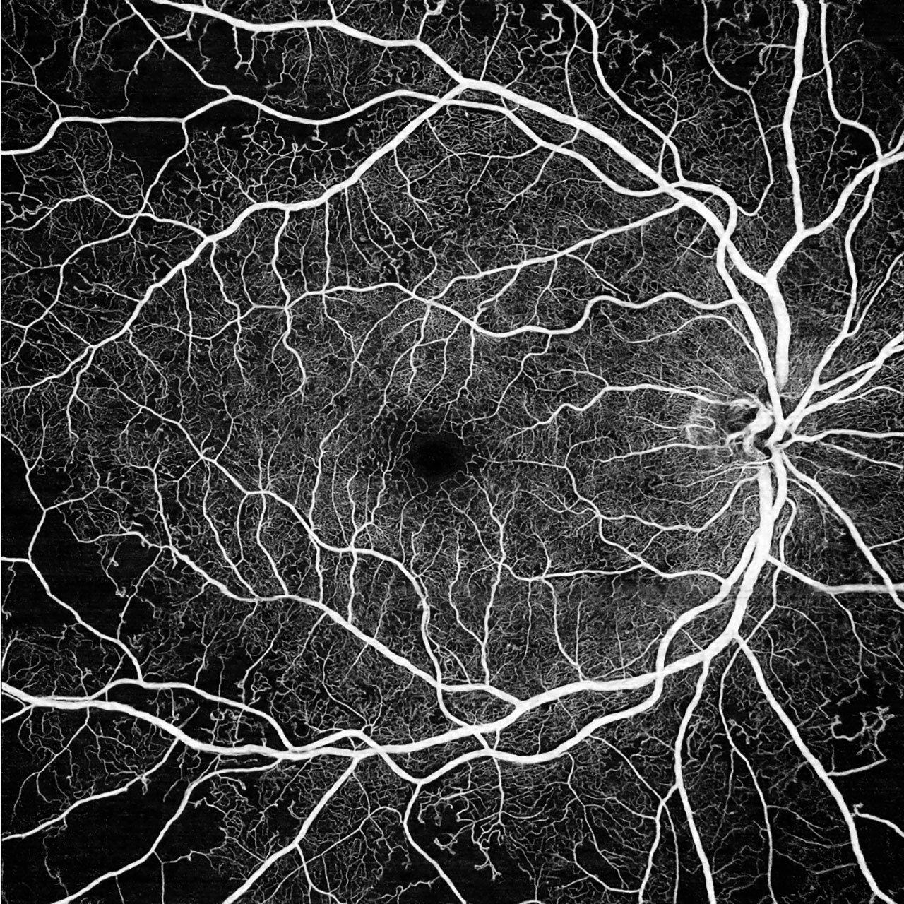 Widefield Octa Advancing Retinal Imaging And Diagnostics Retinal