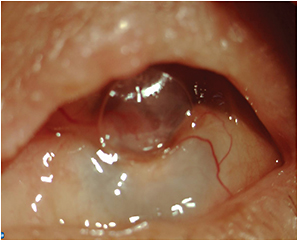 Retinal Physician Pentavision