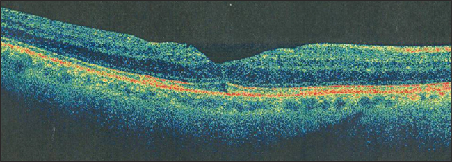 Retinal Physician | PentaVision