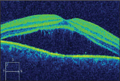 Retinal Physician | PentaVision