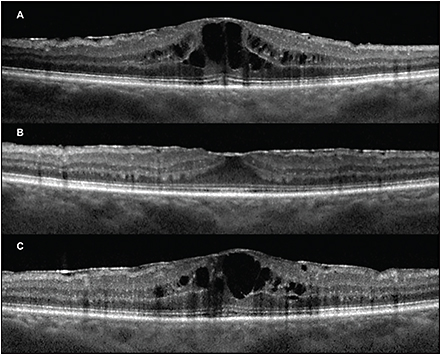 Retinal Physician | PentaVision