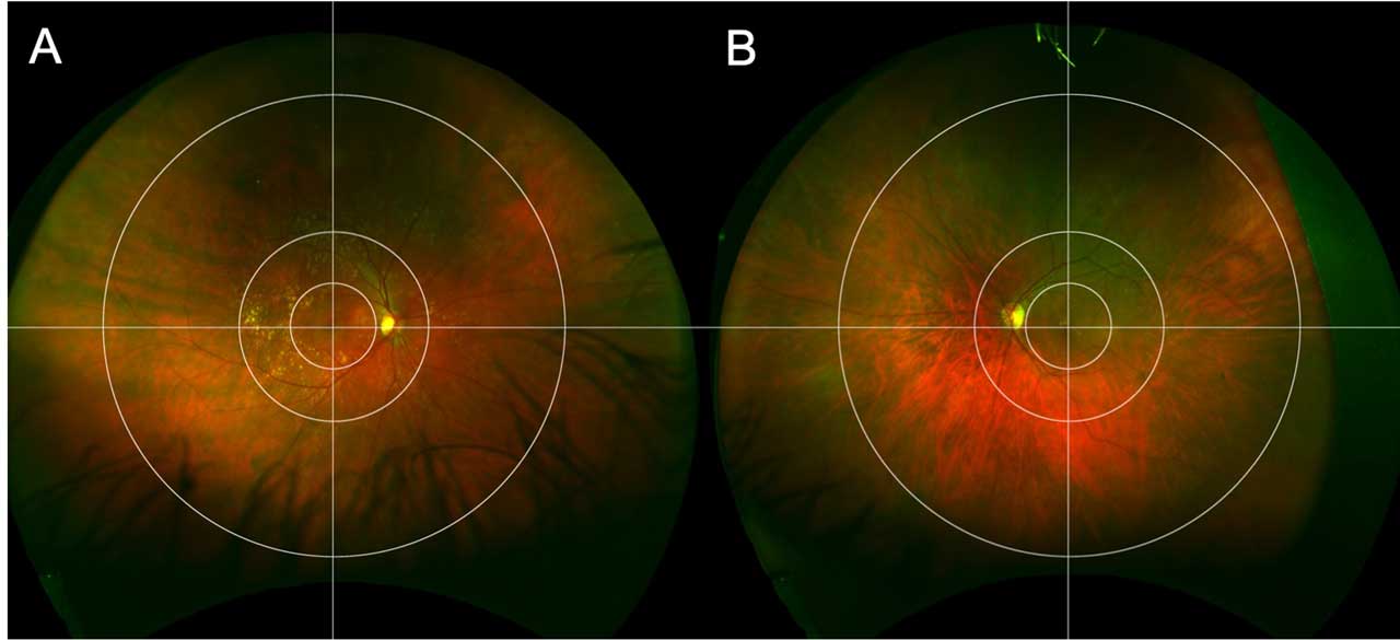Figure 1.  Boston grid9 superimposed on fundus images of right (A) and left (B) eyes. The grid is composed of 3 concentric circles centered on the fovea, separating the retina into central, perimacular, midperipheral, and far-peripheral areas. Horizontal and vertical lines further separate the retina into superior, inferior, temporal, and nasal quadrants, producing a total of 12 zones.