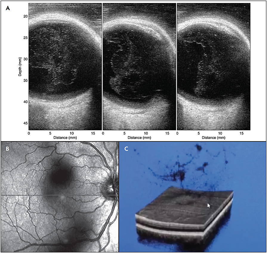Jerry Sebag Episode 78: Vision Degrading Vitreopathy With Dr. Jerry Sebag – DTUQS