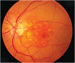 Retinal Physician | PentaVision