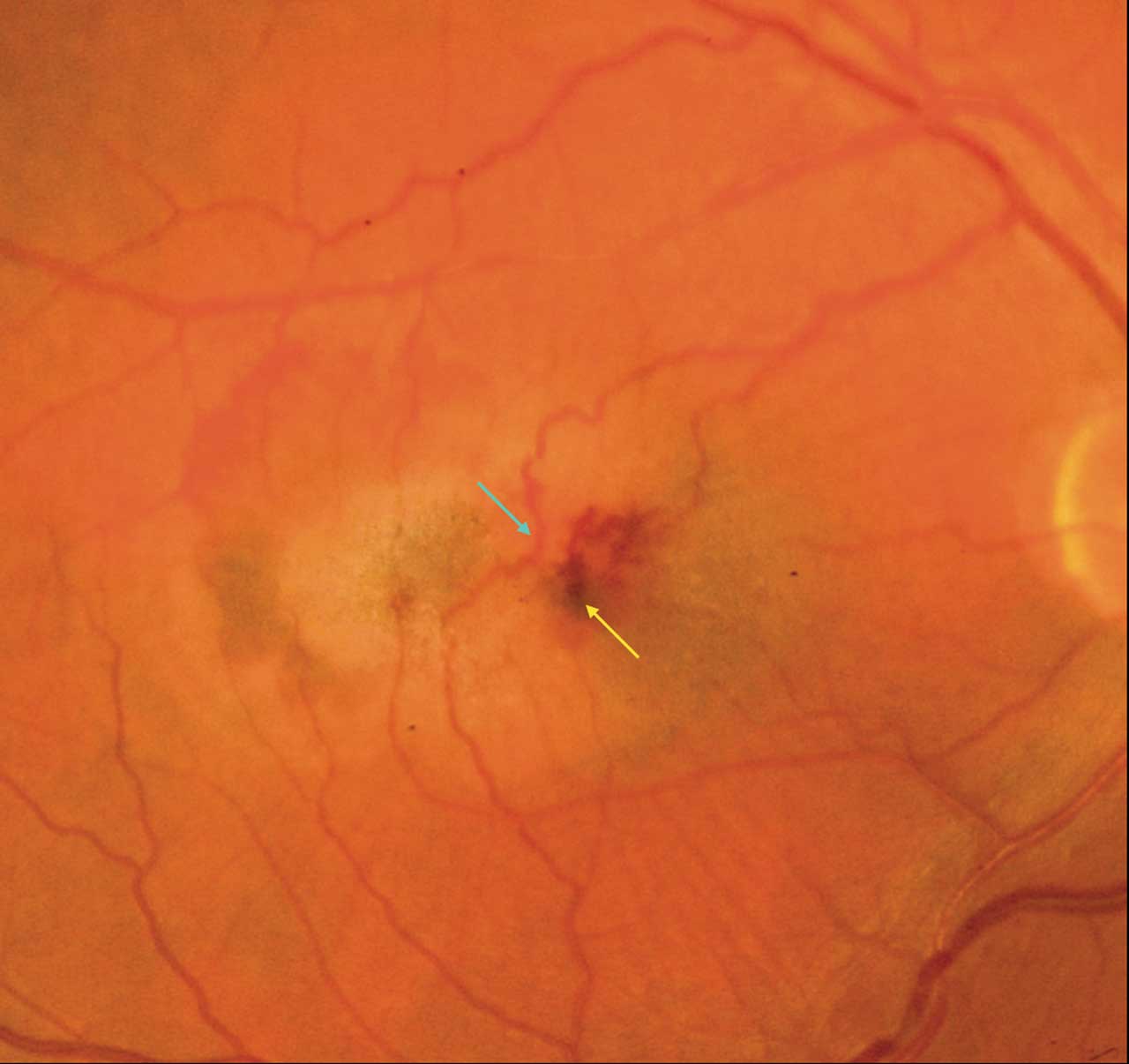 Neovascularization in Macular Telangiectasia | Retinal Physician