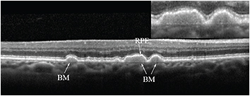 Retinal Physician | PentaVision
