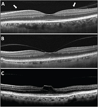 Retinal Physician | PentaVision