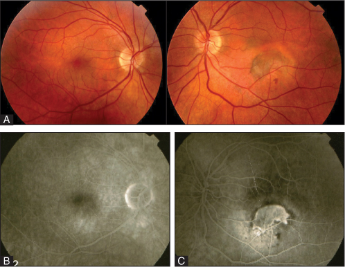 Retinal Physician | PentaVision