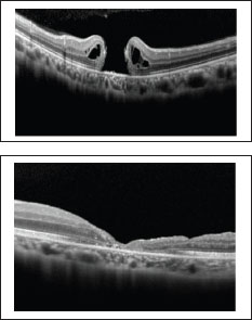 Retinal Physician | PentaVision