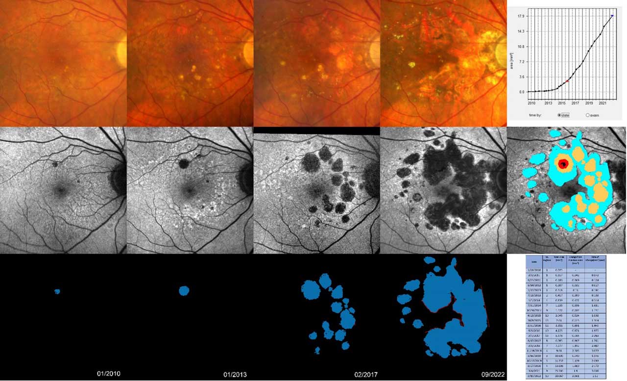 Figure 2. Geographic atrophy (GA) progression mapping using RegionFinder (Heidelberg Engineering). This figure depicts the progression of GA over approximately 13 years in a right eye. Moving from left to right, the first four columns display color fundus photography, fundus autofluorescence, and RegionFinder-based delineations of GA areas at 4 distinct time points. At the initial visit in January 2010, a small atrophic area superior to the fovea is visible, displaying gradual growth until January 2013. By February 2017, there is a marked increase in both the number and total size of atrophic regions. In May 2022, further enlargement is evident, while the fovea remains unaffected by atrophy. The fifth column, top row, features a graphical illustration revealing the initial slow growth, followed by exponential expansion, and later linear growth of the total atrophy size. The middle row of the fifth column presents a differential map, highlighting the expansion of atrophy. The increase in atrophy at the second time point is indicated in red, at the third time point in ocher, and at the fourth time point in light blue, illustrating the comparatively slower progression towards the fovea in contrast to the spread toward the peripheral regions of the macula. In the bottom row of the fifth column, an analysis summary table generated by the RegionFinder software displays numerical values for the number of atrophic regions, the total atrophy area, changes from the previous examination, and the rate of change per year.