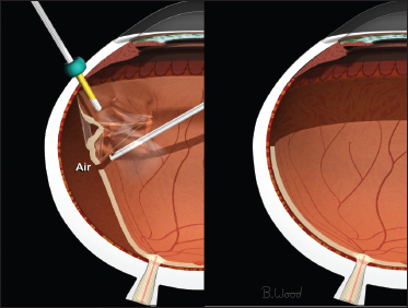 Retinal Physician | PentaVision