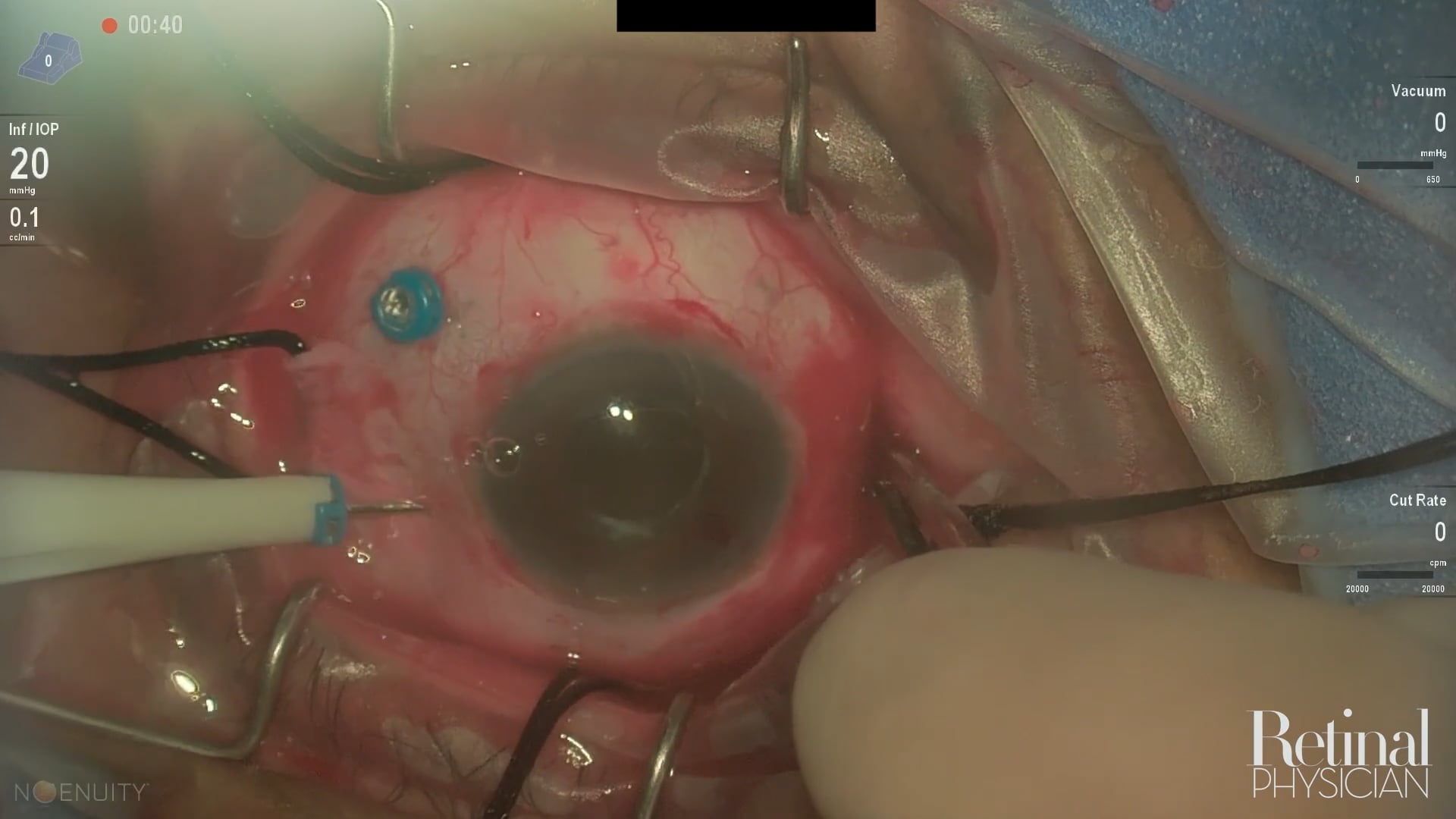 Visualization for Vitrectomy, Video 2