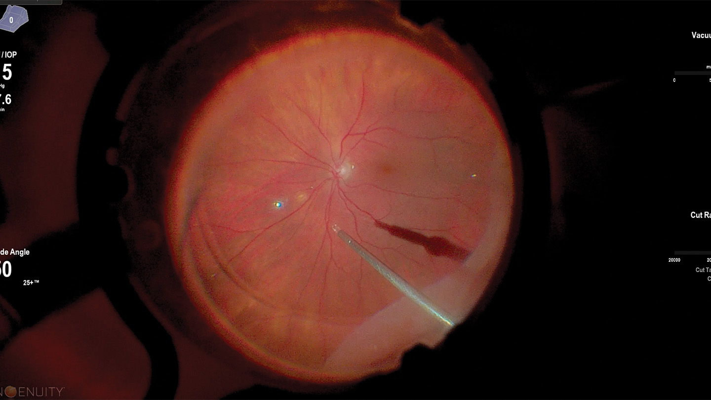 2026 Surgical Roundtable Case 1: Managing Giant Retinal Tears 