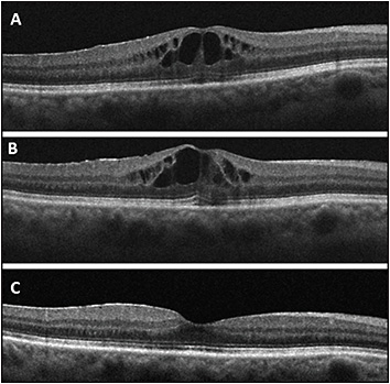 Retinal Physician | PentaVision