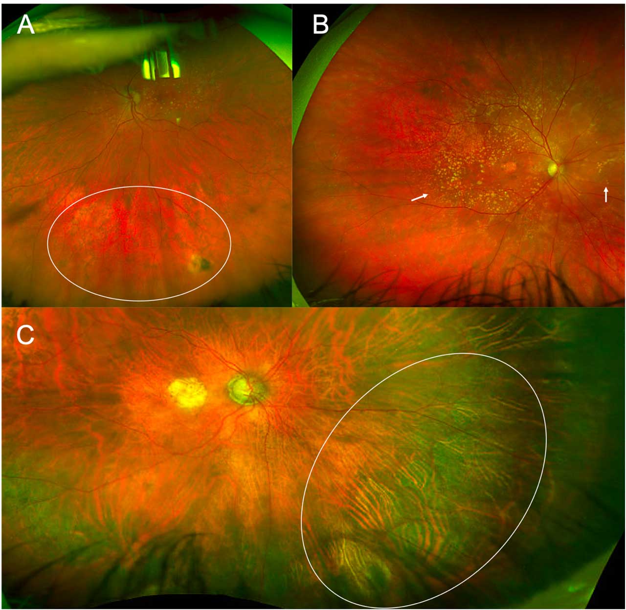 Figure 2. Peripheral retinal changes in AMD, including reticular pigmentary changes (A; white circle), midperipheral drusen (B; examples highlighted with arrows), and atrophy (C; white circle).