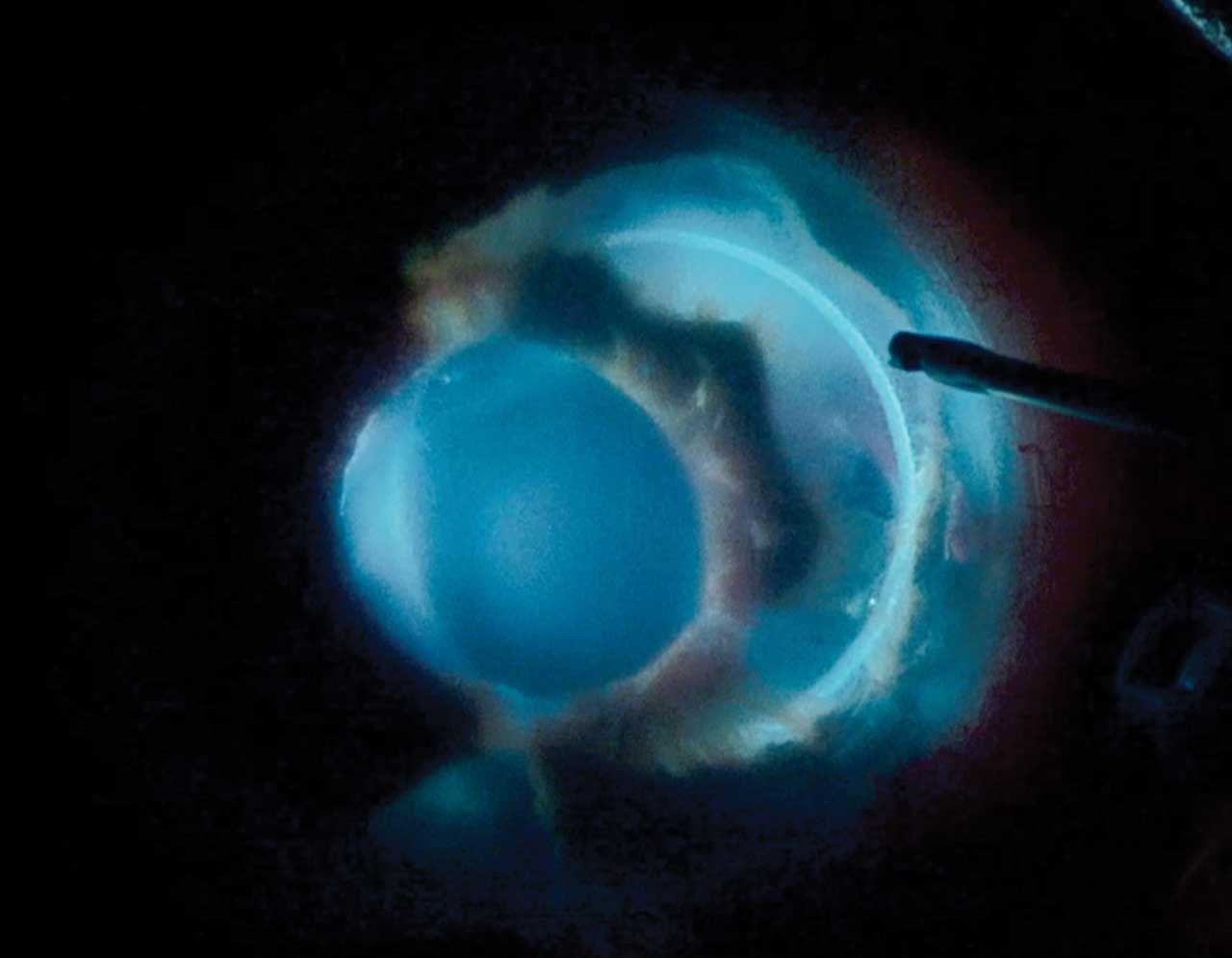 Management of Dislocated Intraocular Lenses | Retinal Physician