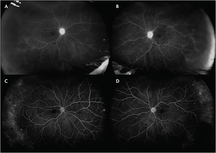 Retinal Physician PentaVision