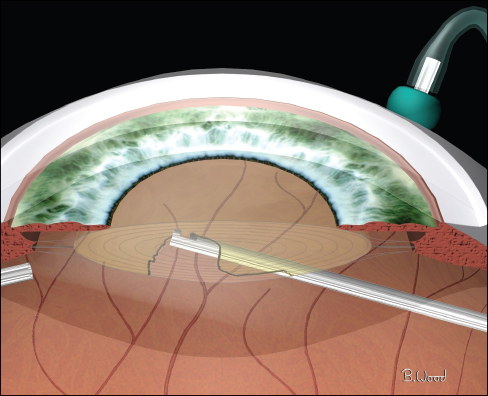 Retinal Physician | PentaVision