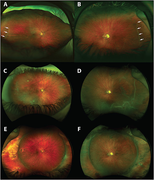 Keeping Up With ICROP | Retinal Physician