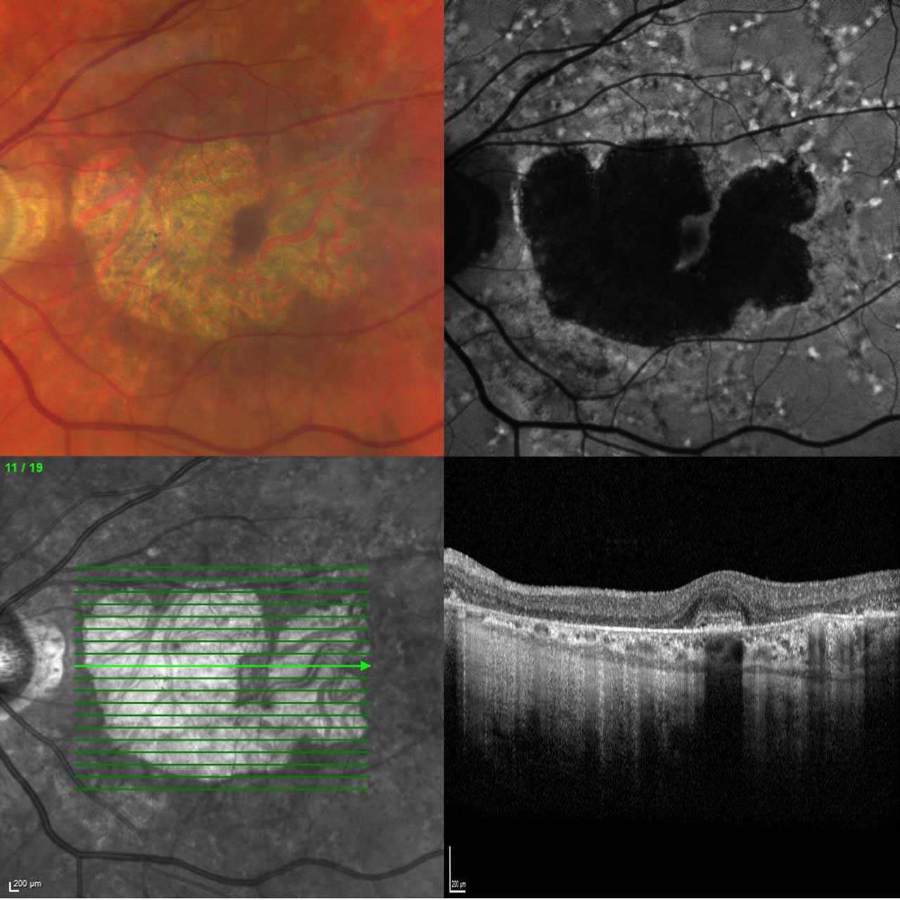 Figure 3. Atrophy secondary to Stargardt macular dystrophy (70-year-old patient with biallelic pathogenic variants in the ABCA4 gene). Color fundus photography, fundus autofluorescence, and optical coherence tomography with scan location indicated on near-infrared image.