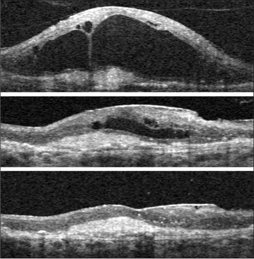 Retinal Physician | PentaVision