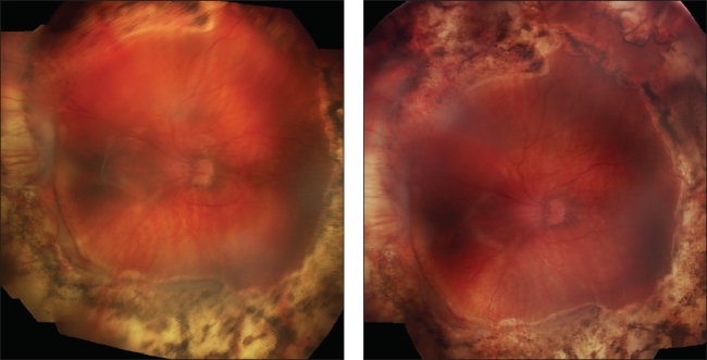 Retinal Physician | PentaVision