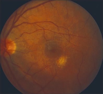 Retinal Physician | PentaVision