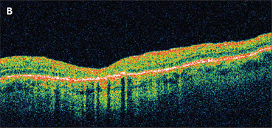 Retinal Physician | PentaVision