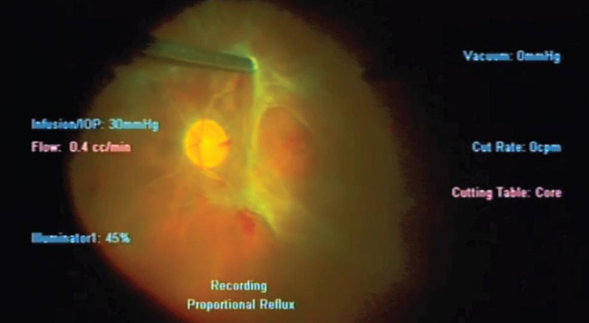 Retinal Physician Pentavision