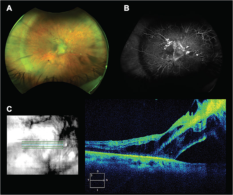 Retinal Physician | PentaVision