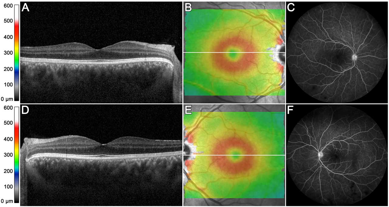 Figure 3. A 21-year-old male with anterior and intermediate uveitis from tubulointerstitial nephritis and uveitis syndrome in both eyes. Optical coherence tomography B-scans show no evidence of cystoid macular edema in either eye (A, D). Retinal thickness maps demonstrate slight perifoveal thickening but otherwise normal (B, E). Late frames on fluorescein angiography demonstrate minimal far peripheral retinal vasculitis, but no angiographic cystoid macular edema or optic nerve hyperfluorescence (C, F).