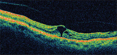 Retinal Physician | PentaVision