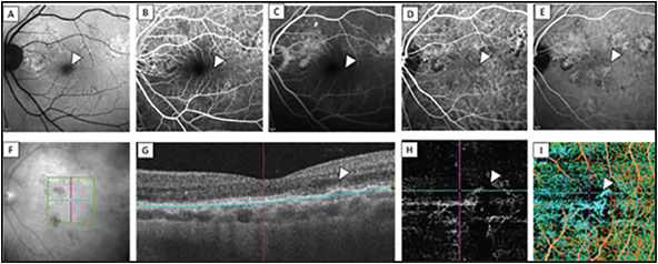 Retinal Physician | PentaVision