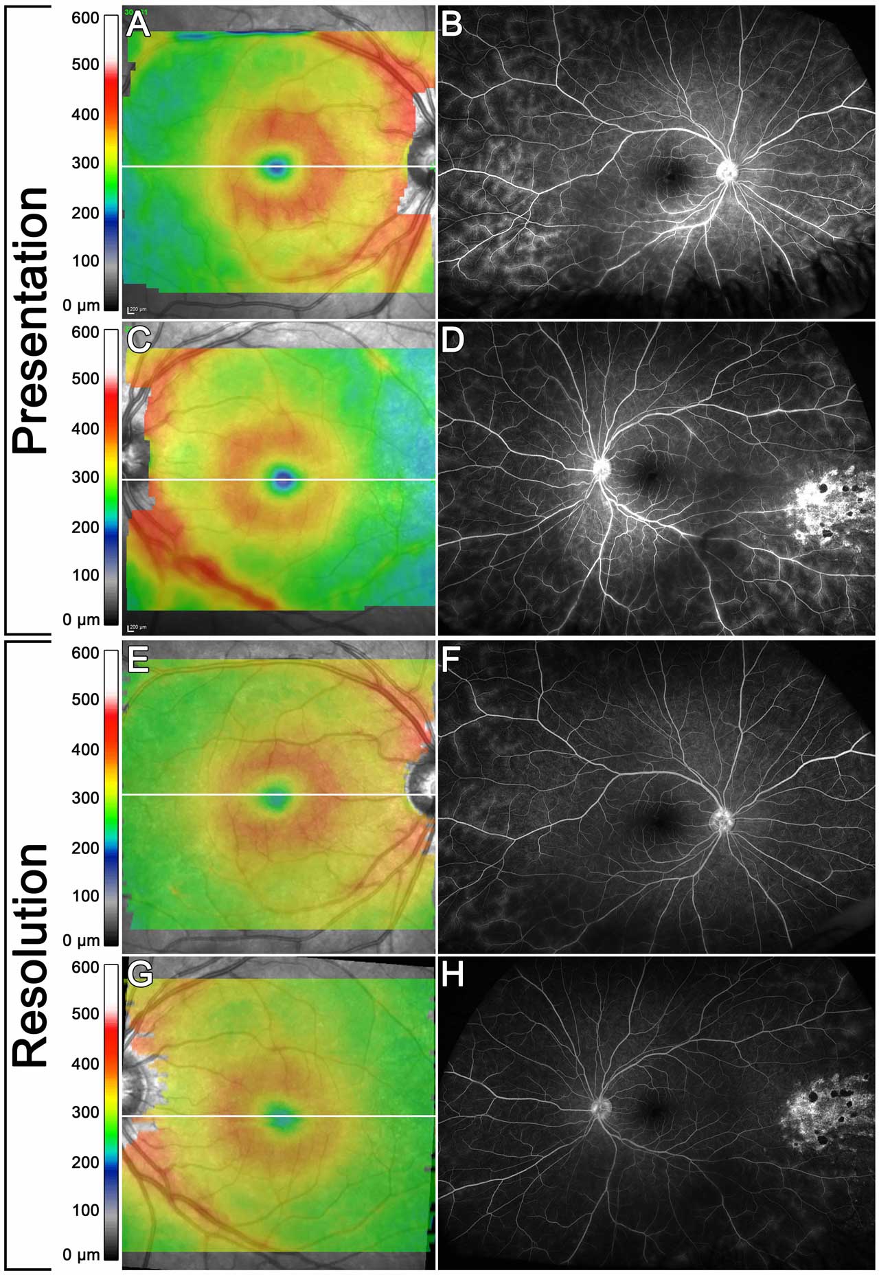 Figure 2. A 17-year-old male with intermediate uveitis and retinal vasculitis in both eyes. On presentation, retinal thickness maps demonstrate perivascular and perifoveal thickening in both eyes (A, C). Late frames of fluorescein angiography demonstrate large-vessel vasculitis in the midperiphery more in the right than left eye, with staining of laser scars temporally in the left eye (B, D). After treatment, retinal thickness maps show significant reduction of perivascular thickness (E, G). Fluorescein angiography shows significant improvement of vasculitis (F, H).