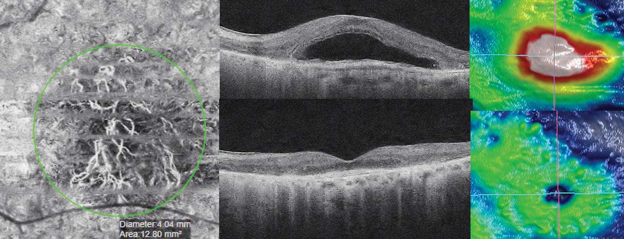 Figure 1. Left, optical coherence tomography (OCT) angiography image of active subfoveal macular neovascularization in the left eye on presentation in 2020. Top middle and top right, OCT and internal limiting membrane‒retinal pigment epithelium slab on presentation showing associated subretinal fluid. Bottom middle and bottom right, OCT and internal limiting membrane‒retinal pigment epithelium slab in 2023 showing resolution of fluid and disruption of central macular photoreceptors, at this point on q4 month anti-VEGF following a treat-and-extend paradigm. Should dosing continue?