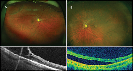 Retinal Physician | PentaVision