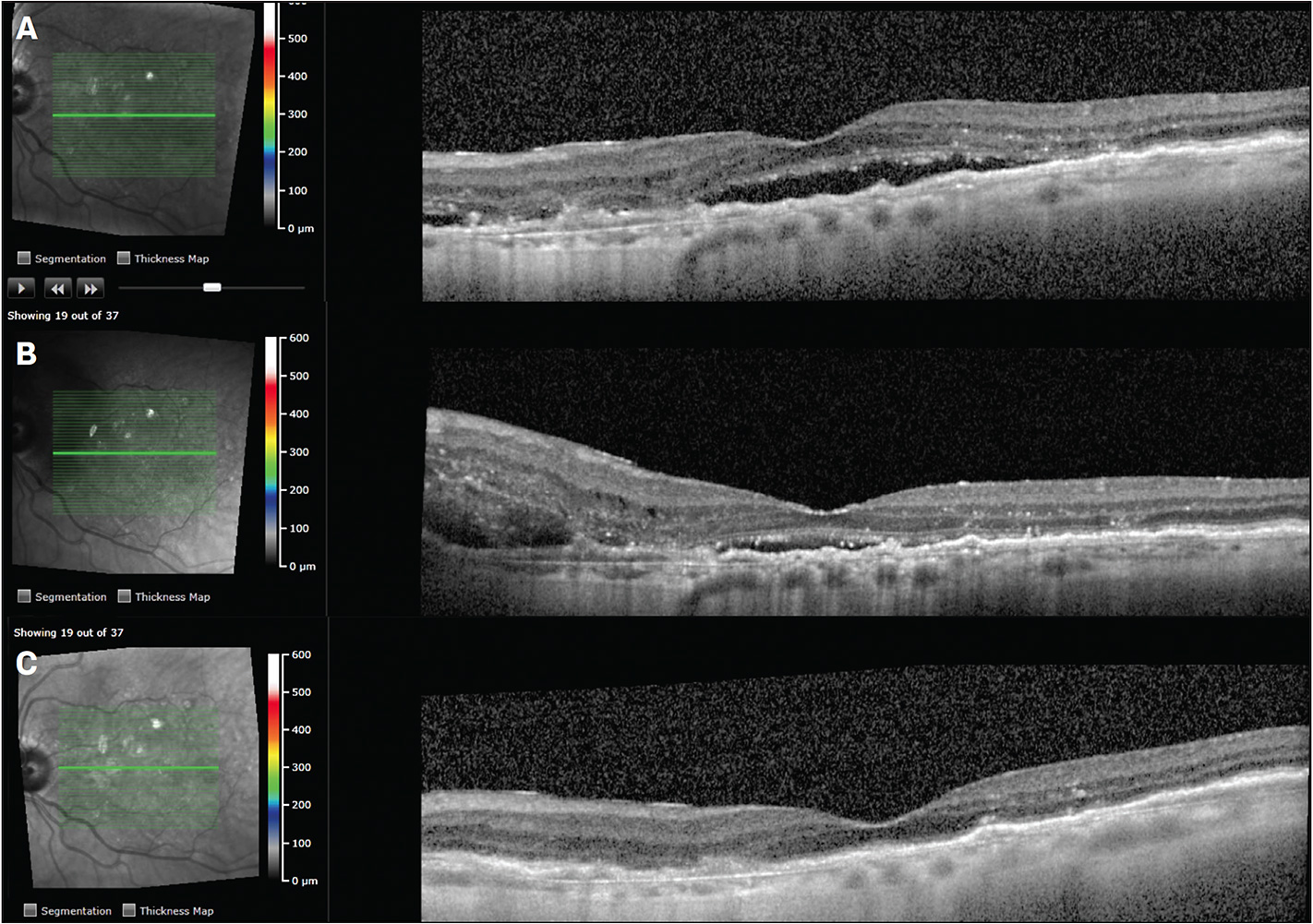 Retinal Physician | PentaVision