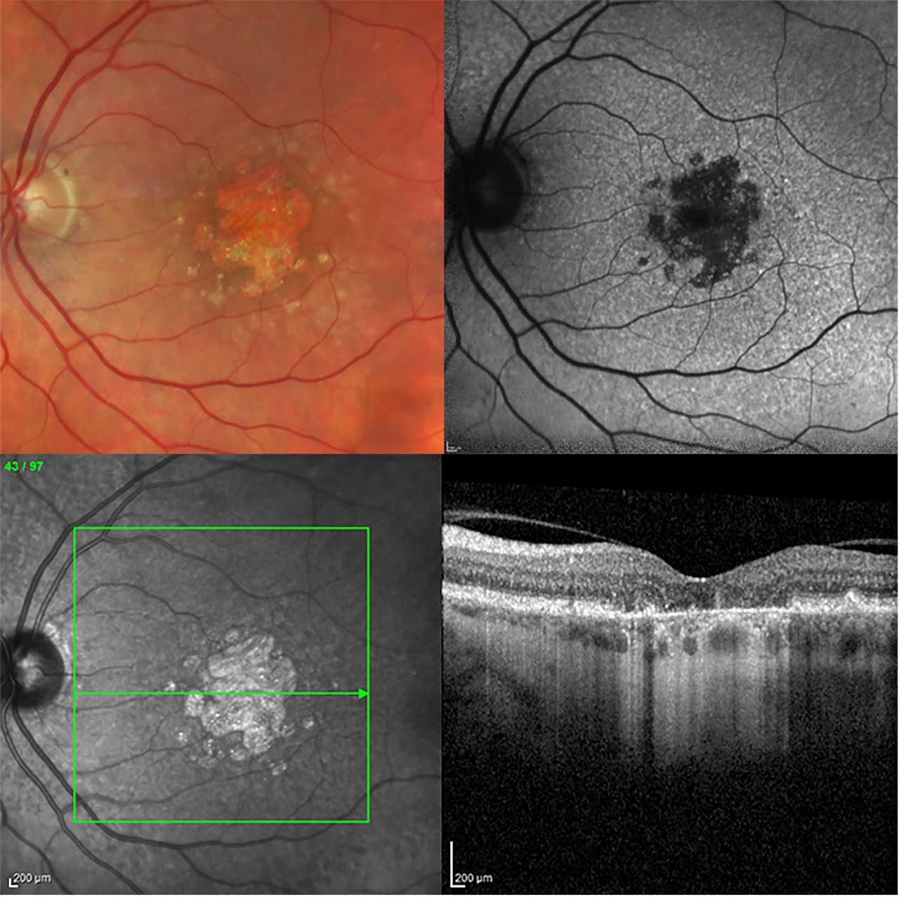 Figure 1. Geographic atrophy secondary to AMD (left eye of a 69-year-old  patient). Color fundus photography, fundus autofluorescence, and optical  coherence tomography with scan location indicated on near-infrared image.
